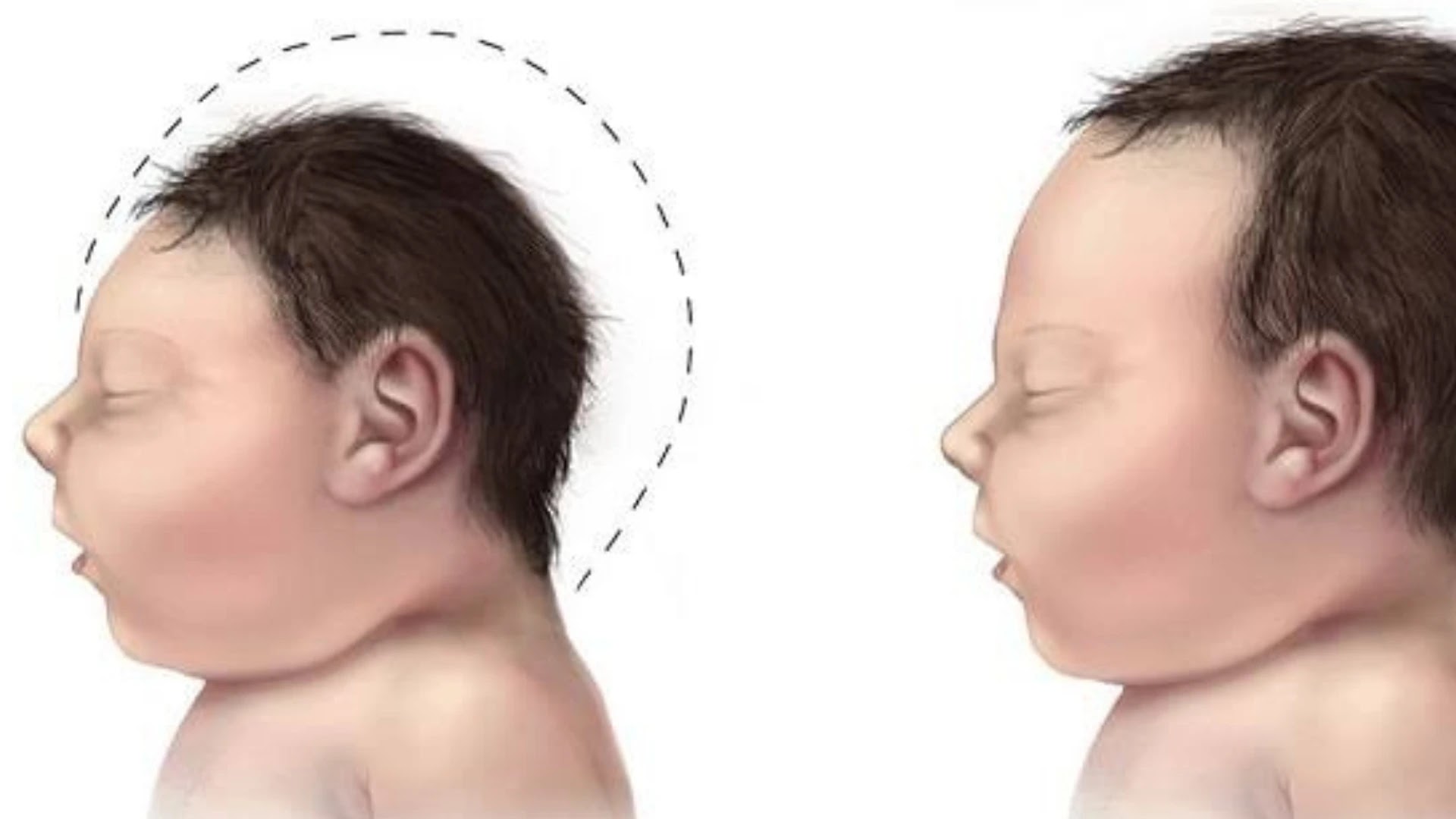 Strategi Intervensi Dini untuk Anak-anak dengan Mikrosefali