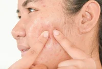 Apakah Kacang Menyebabkan Jerawat?