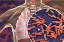 Tuberkulosis (TBC)