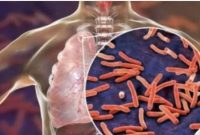 Tuberkulosis (TBC)