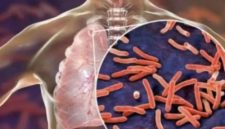 Tuberkulosis (TBC)