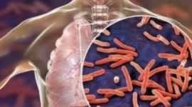 Tuberkulosis (TBC)