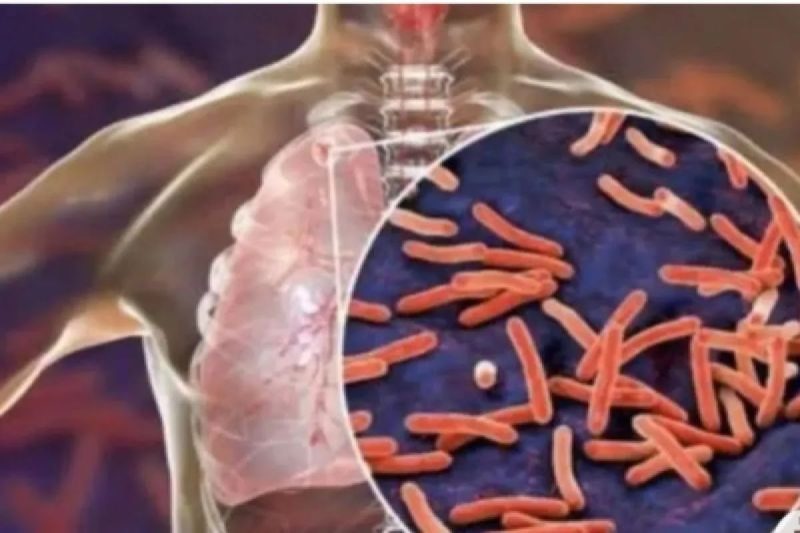 Tuberkulosis (TBC)