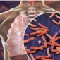 Tuberkulosis (TBC)