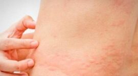 Kenapa Biduran Sering Kambuh di Malam Hari