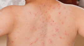 Penyebab Campak dan Mengatasinya