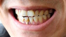 Cara Membersihkan Karang Gigi yang Benar