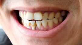 Cara Membersihkan Karang Gigi yang Benar