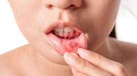 Cara Cepat Menyembuhkan Sariawan yang Ampuh 