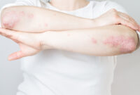 Cara Membersihkan Darah Kotor Penyebab Gatal