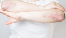 Cara Membersihkan Darah Kotor Penyebab Gatal