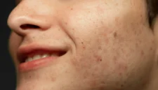 Cara Menggunakan Minyak Zaitun untuk Wajah Flek Hitam