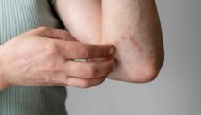 Cara Mengobati Campak